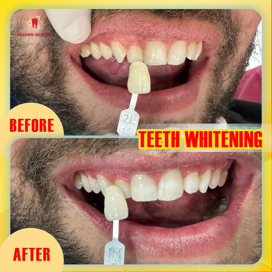professional teeth whitening in ho chi minh city