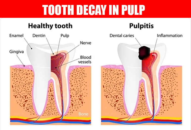 tooth decay in pulp