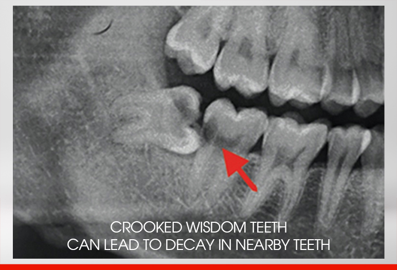 Crooked wisdom teeth can lead to decay in nearby teeth