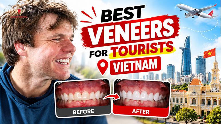 best veneer for tourist vietnam