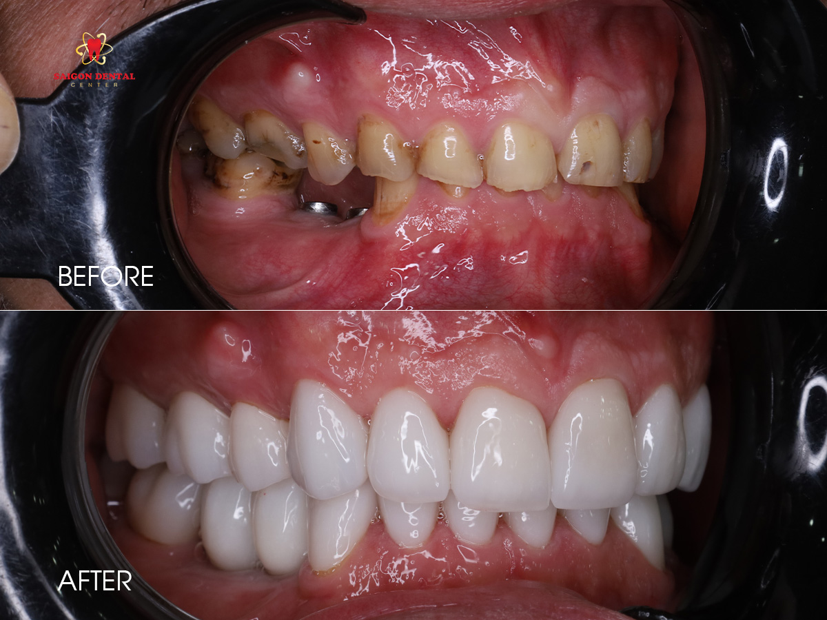 dental restoration ho chi minh dental veneer saigon