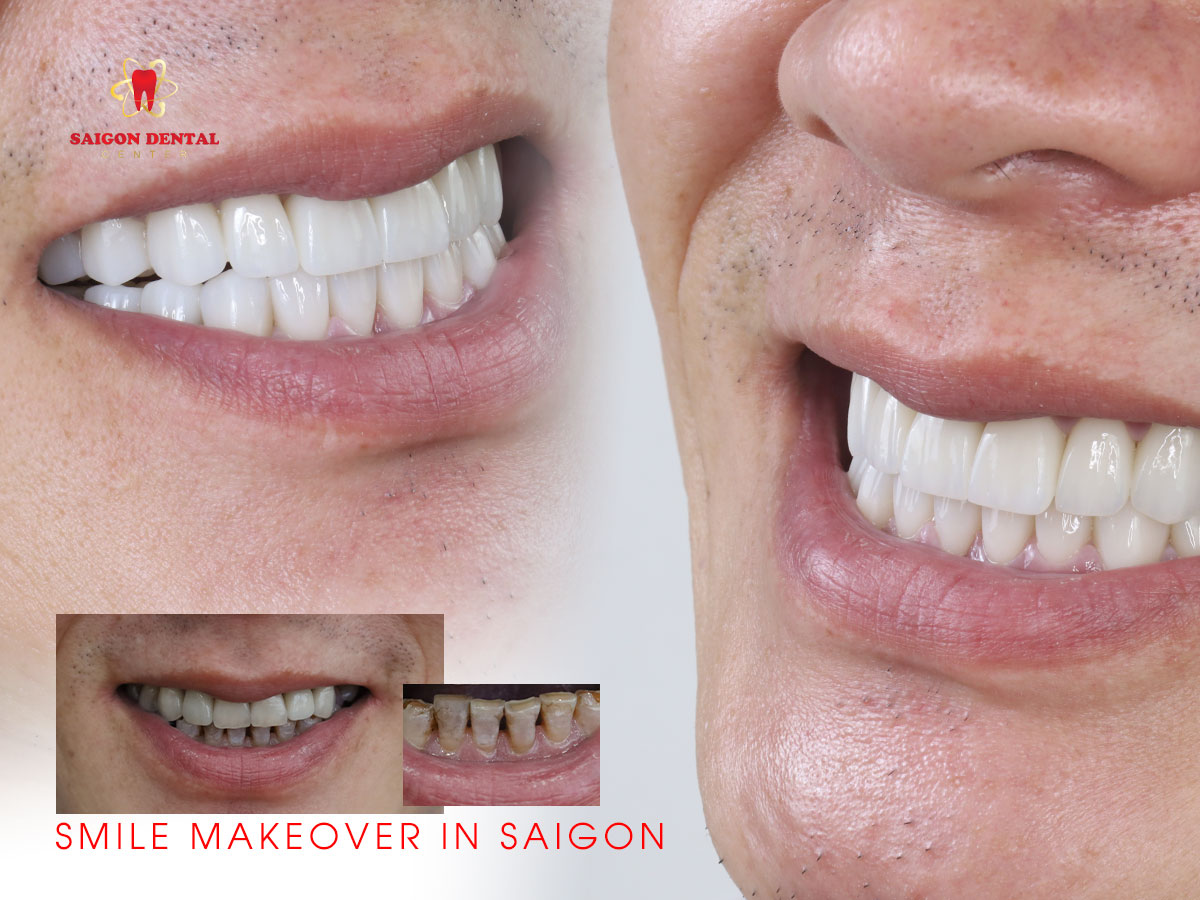 smile makeover
