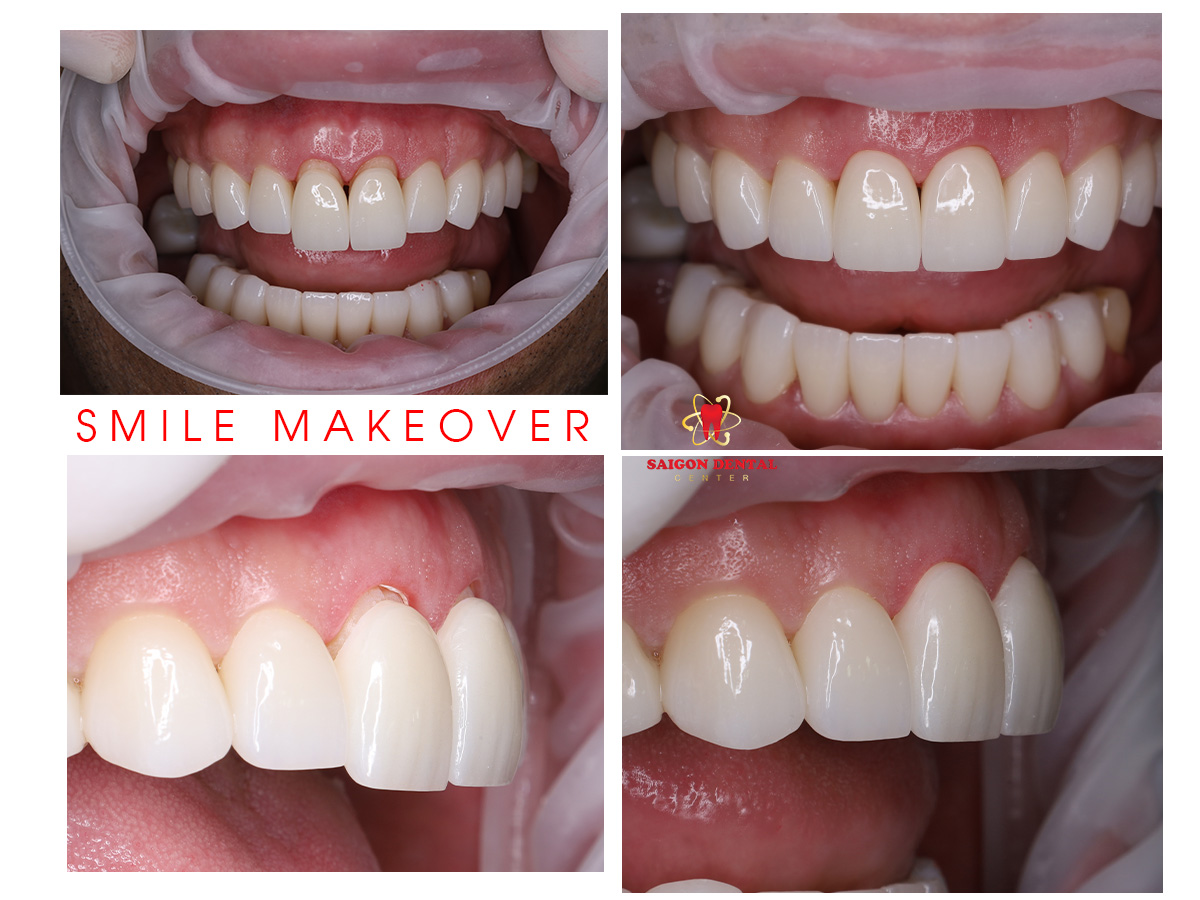 smile makeover porcelain veneer in saigon Cosmetic dentistry in saigon