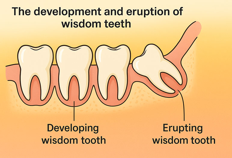 Are Crooked Wisdom Teeth Bad Saigon Center Dental Clinic Are Crooked Wisdom Teeth Bad Saigon Center Dental Clinic