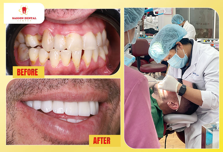 getting dental crowns in vietnam
