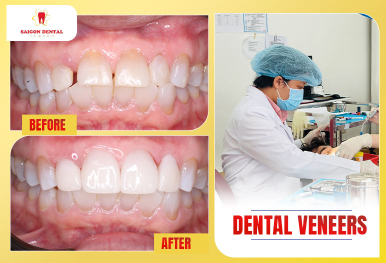 best dentist for dental veneers