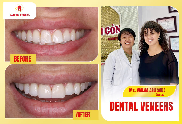 getting dental crowns