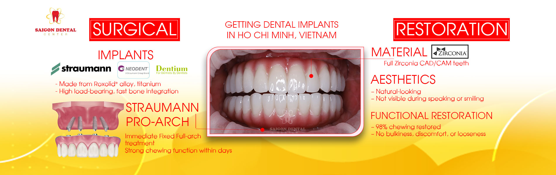 best dental implants