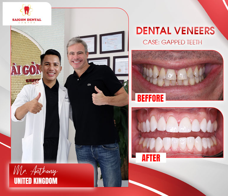 getting dental veneers