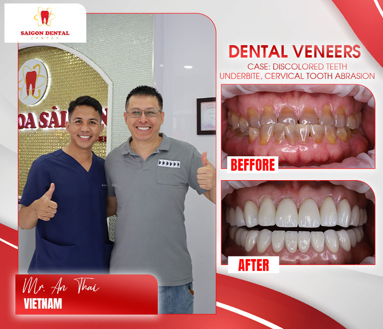 Dental veneers