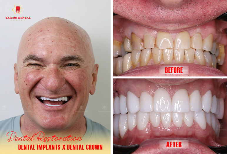 dental implant before after