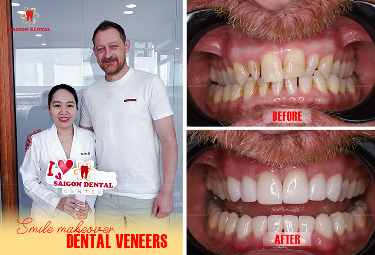 best dental veneer in saigon