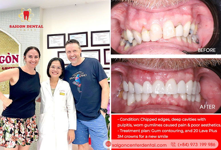 dental crown vietnam