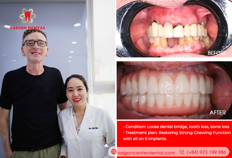 fixed dental implant