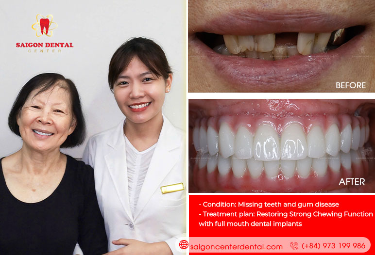 Best all on implants