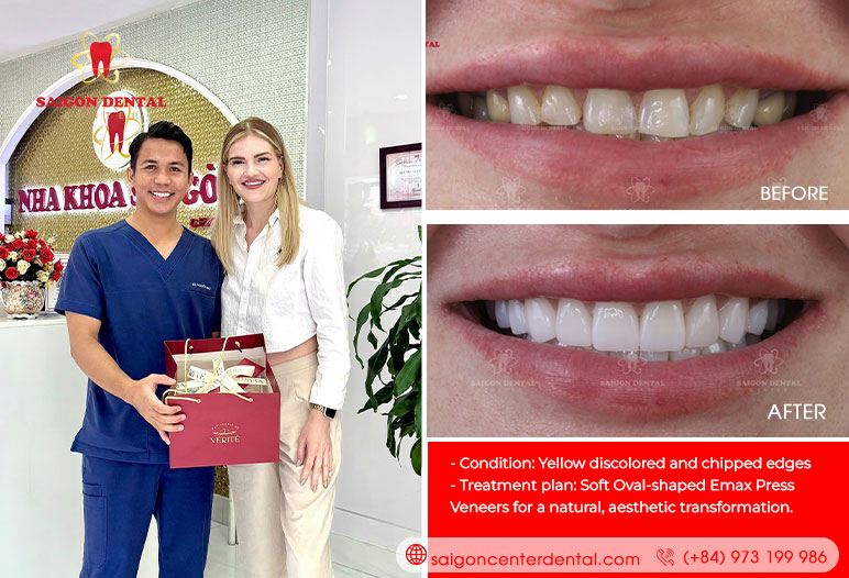 best dental veneers in saigon