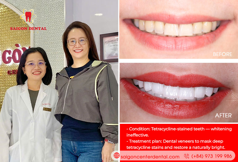 best dental veneer in vietnam