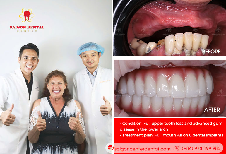 Full mouth dental implant