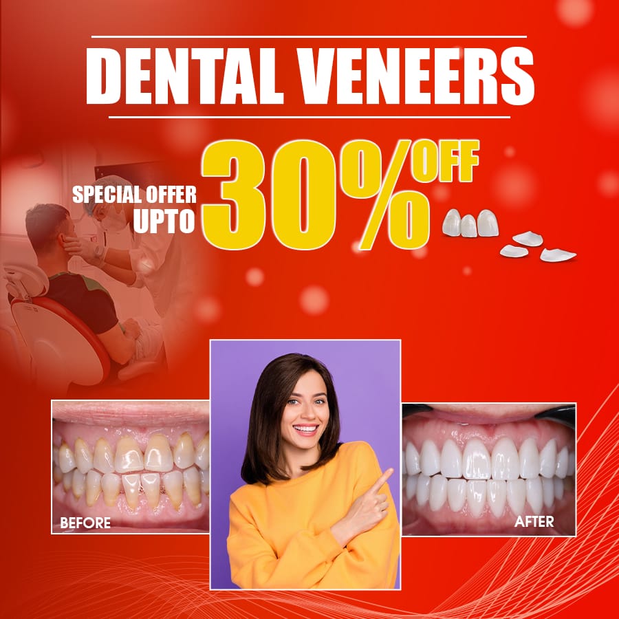 best dental veneer
