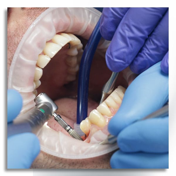 dental implant surgery