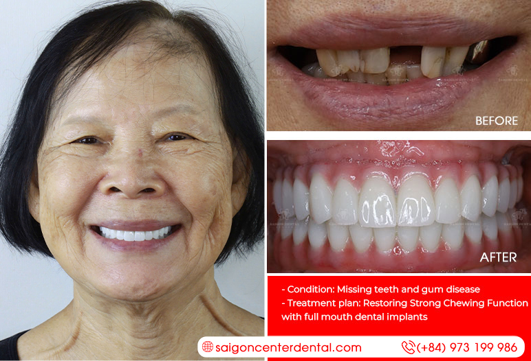 Restoring Strong Chewing Function with dental implants