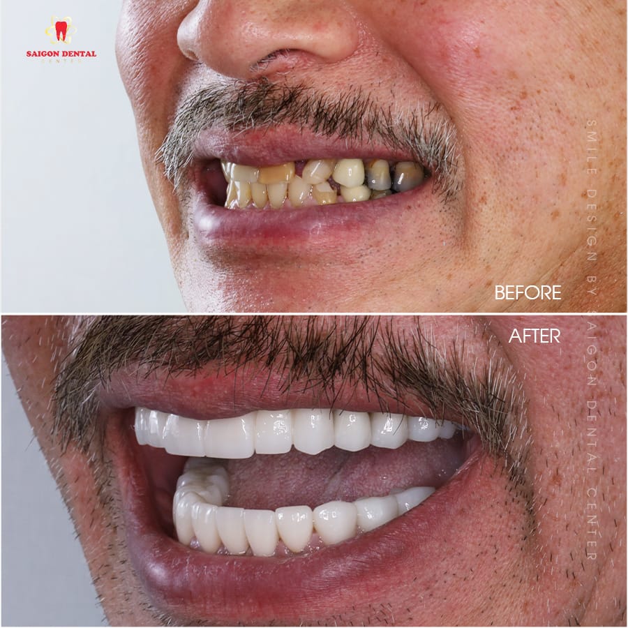 best dental crown vietnam