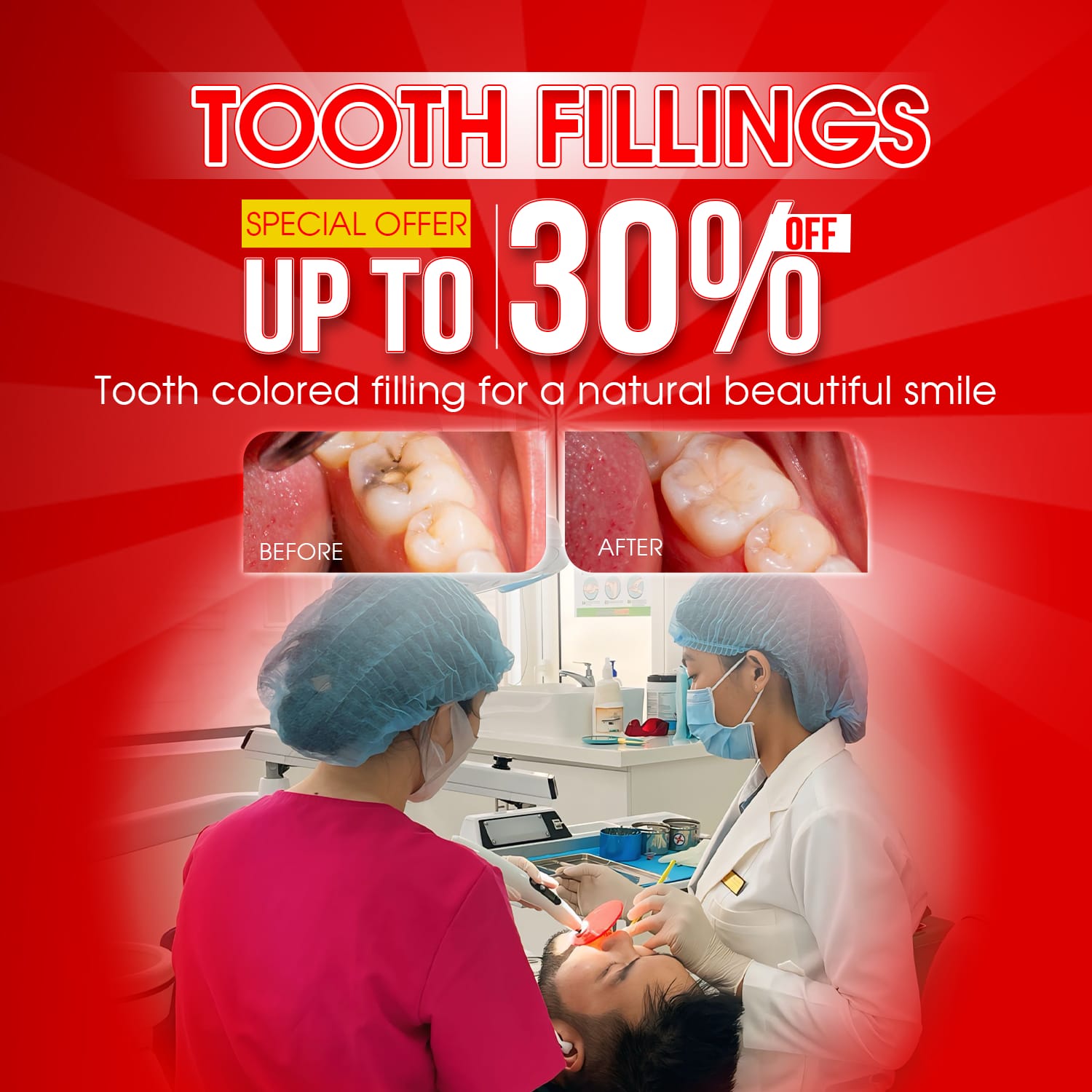 dental fillings