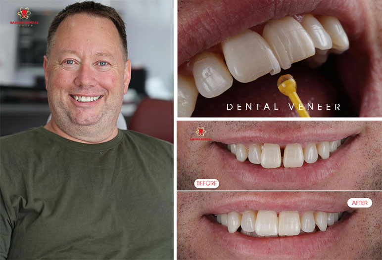 best dental veneer in saigon