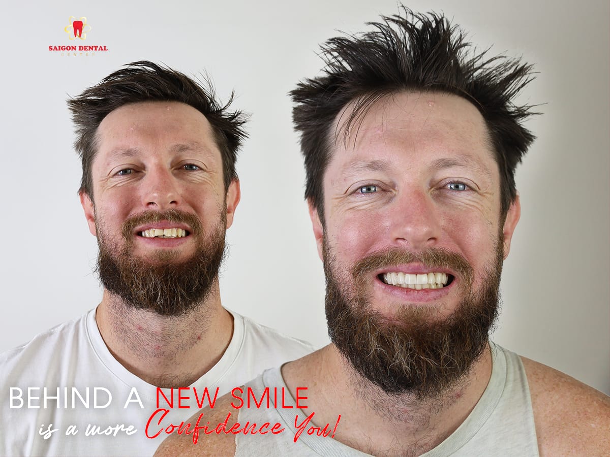 Smile transformation dental veneers