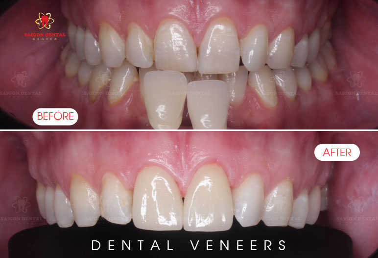 cosmetic dentistry in vietnam