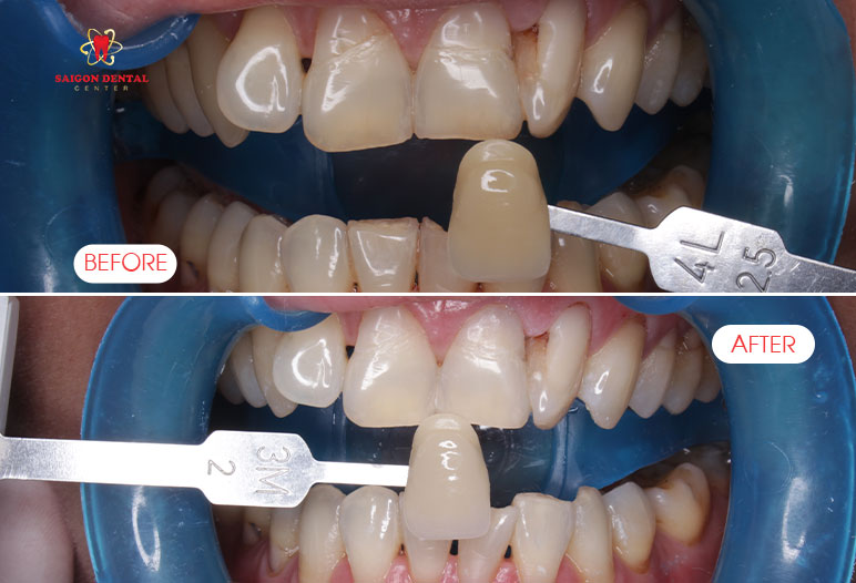 Teeth whitening in saigon