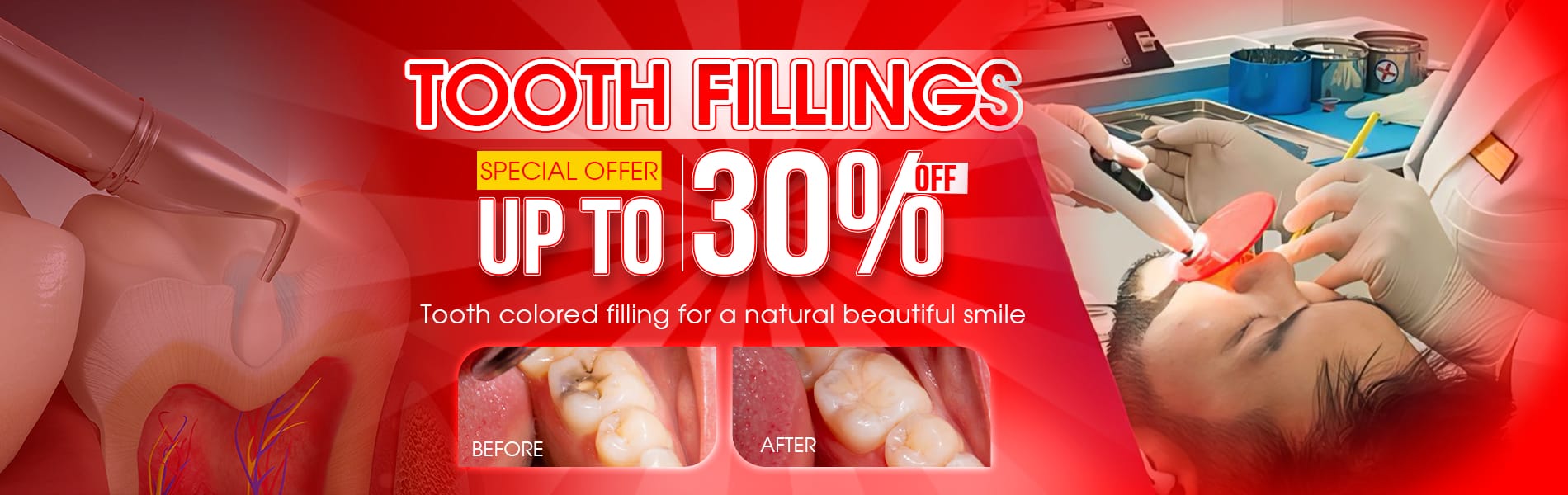 tooth fillings in vietnam