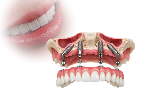 best full-arch dental implants