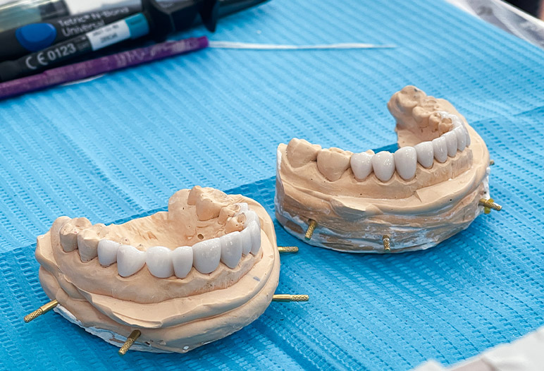 best porcelain veneer
