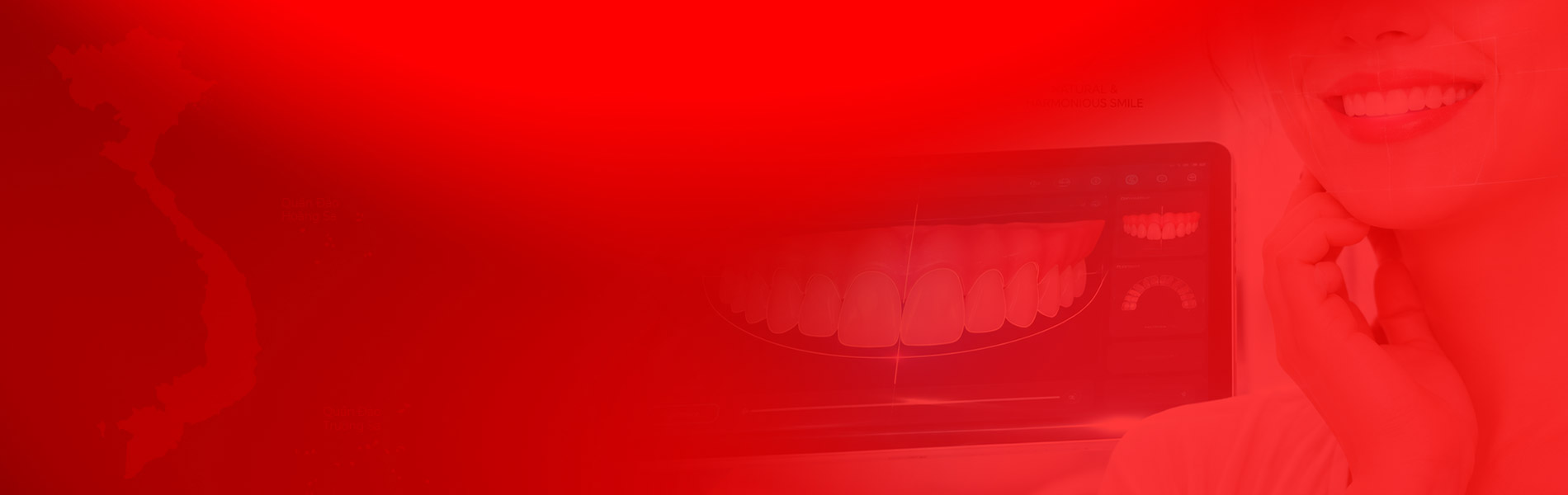 dental veneer 1