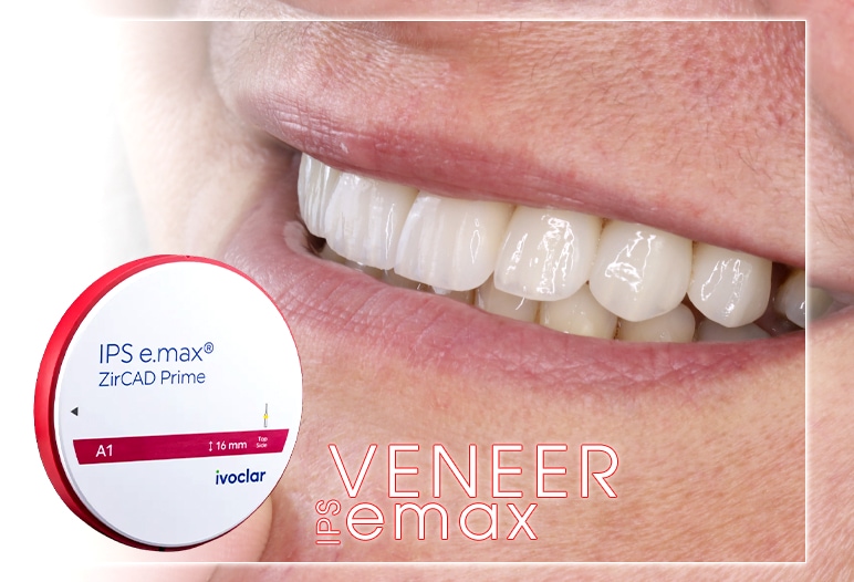 emax veneer