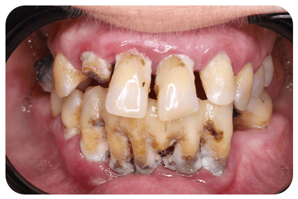 gum disease