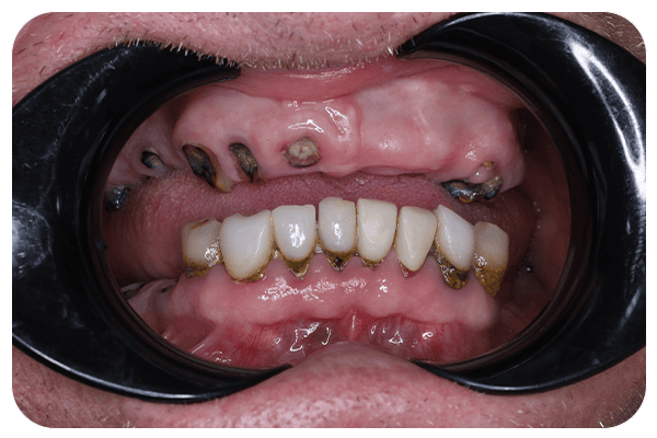 missing tooth 1