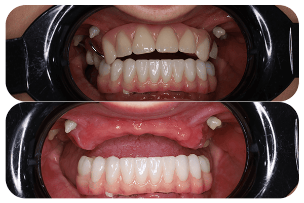 removal denture