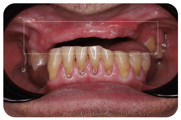tooth loss