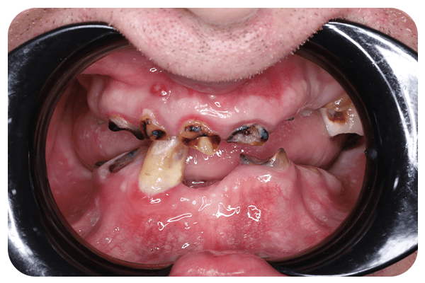 total missing teeth