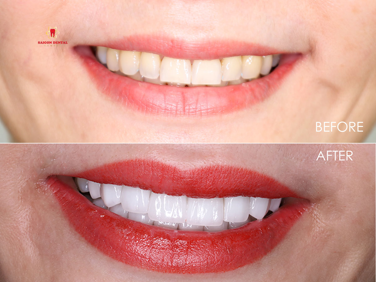porcelain veneers