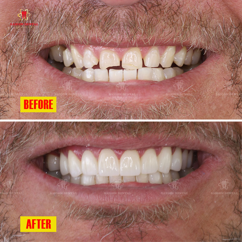 fixed the chipped teeth