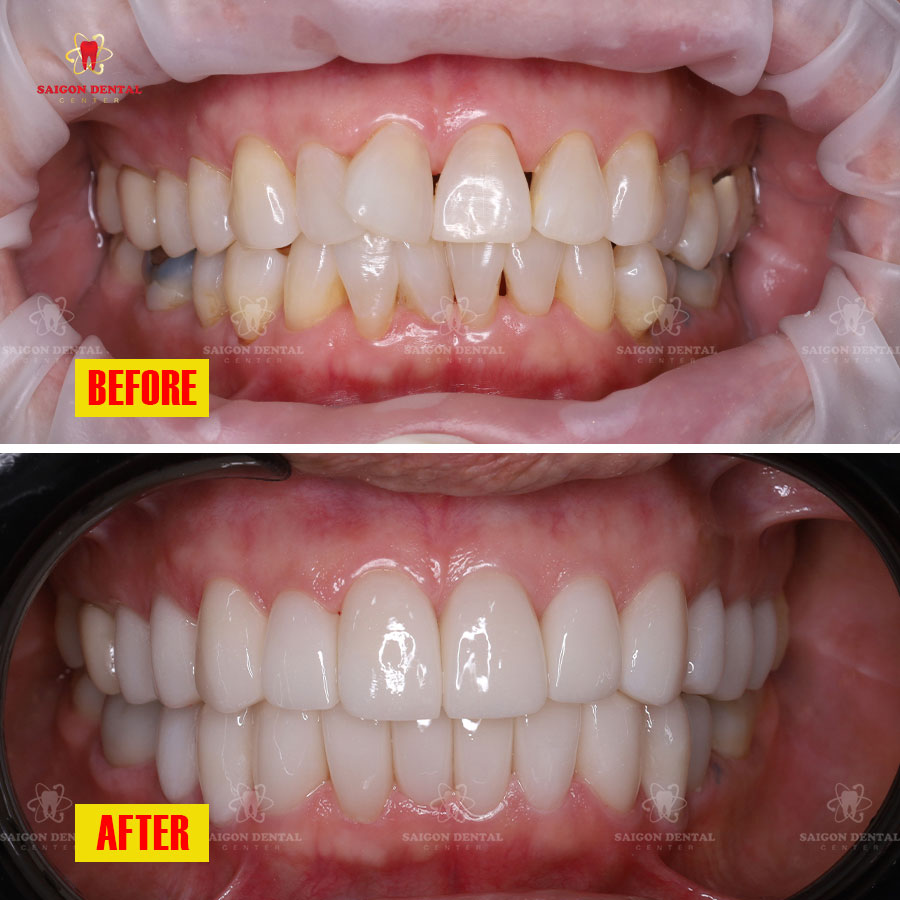 fixing the teeth